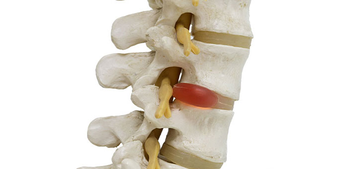 Herniated disc in spine before visiting Sandpoint chiropractor