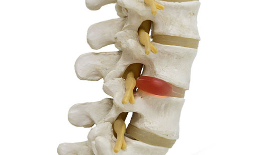 Herniated disc in spine before visiting Sandpoint chiropractor