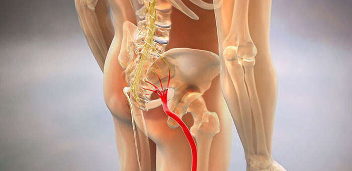 Sciatic nerve pain before chiropractic treatment from Sandpoint chiropractor