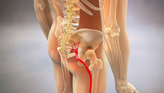 Sciatic nerve pain before chiropractic treatment from Sandpoint chiropractor